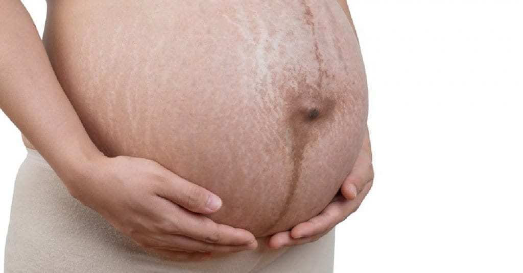 Pregnant belly with stretch marks